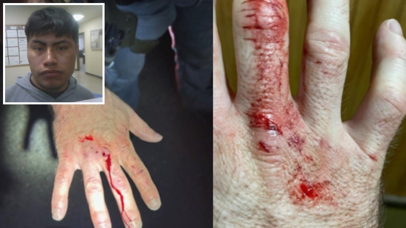 ICE Officer Bitten by Violent Illegal Alien in Louisiana